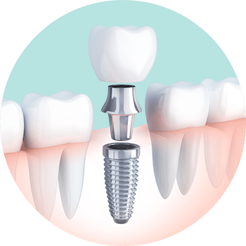 Schéma-Implants-Dentaires