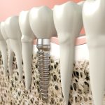 Avantages Implant Dentaire