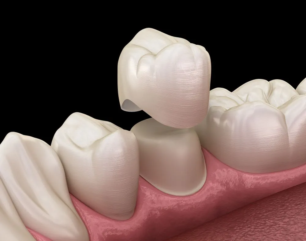 Couronne dentaire en 3D