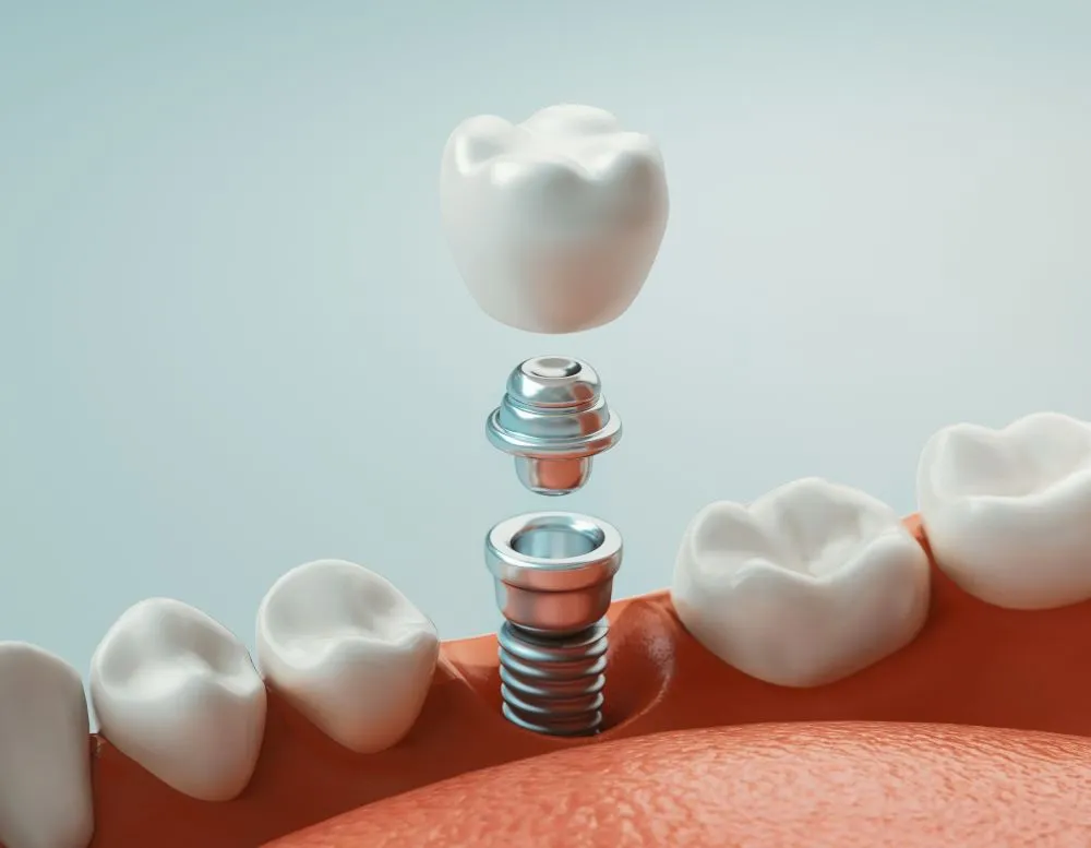 Implant dentaire en 3D