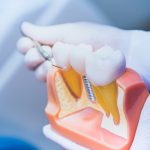 duree-de-vie-implant-dentaire