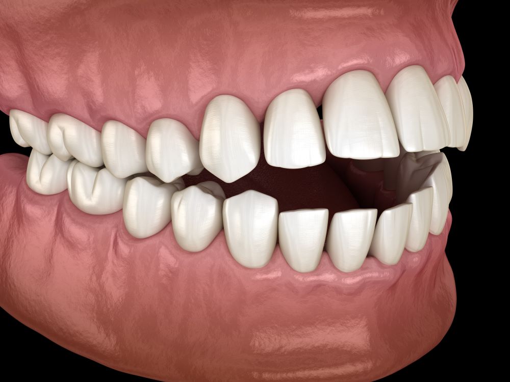Traitement de malocclusions dentaires avec manque d'espace