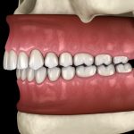 Une représentation 3D de la malocclusion dentaire de classe 2