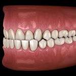 malocclusion-dentaire-classe-3