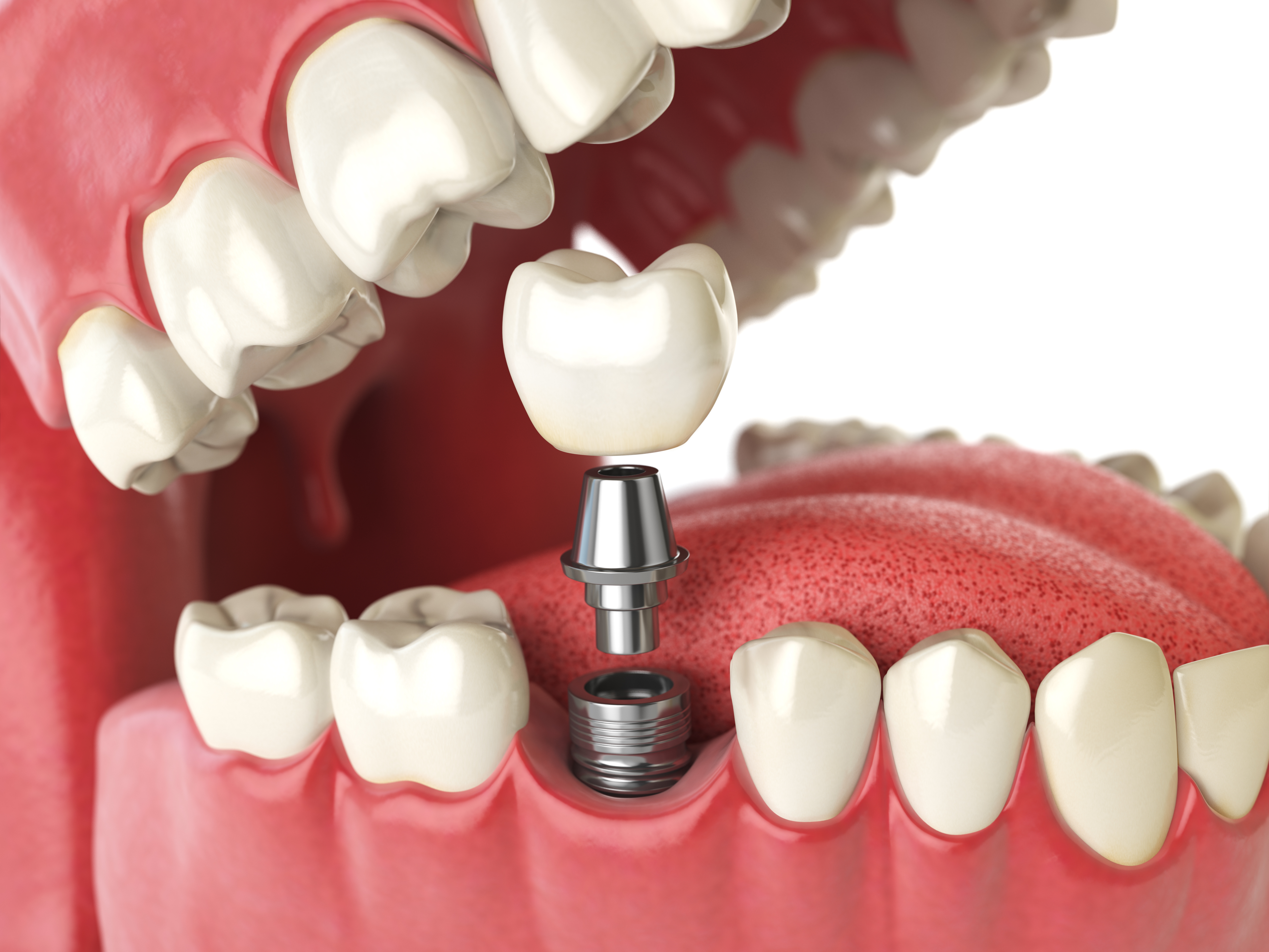 What are the different types of dental prostheses - Crown on implant