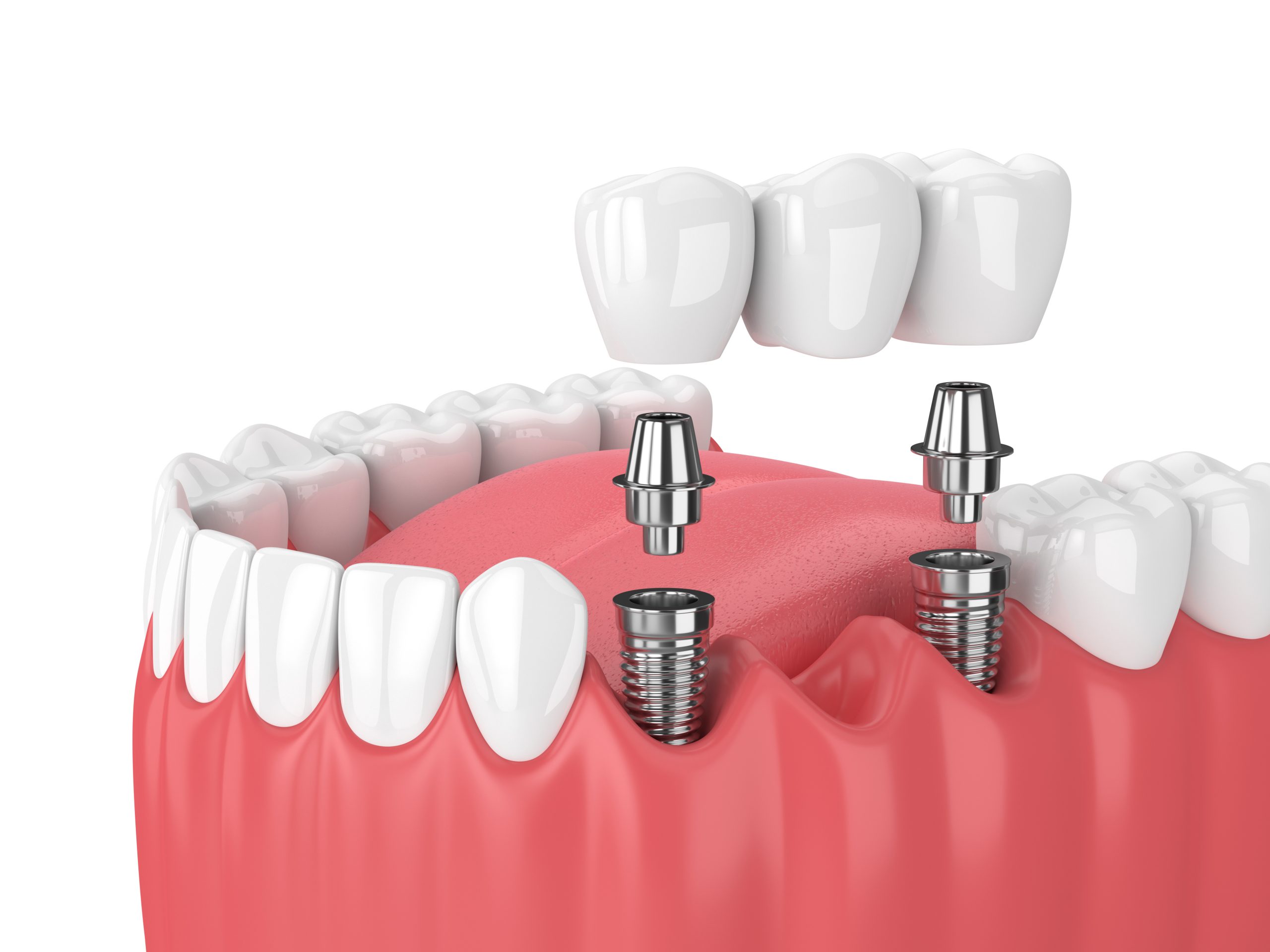 Quels sont les différents types de prothèses dentaires – Pont sur implants