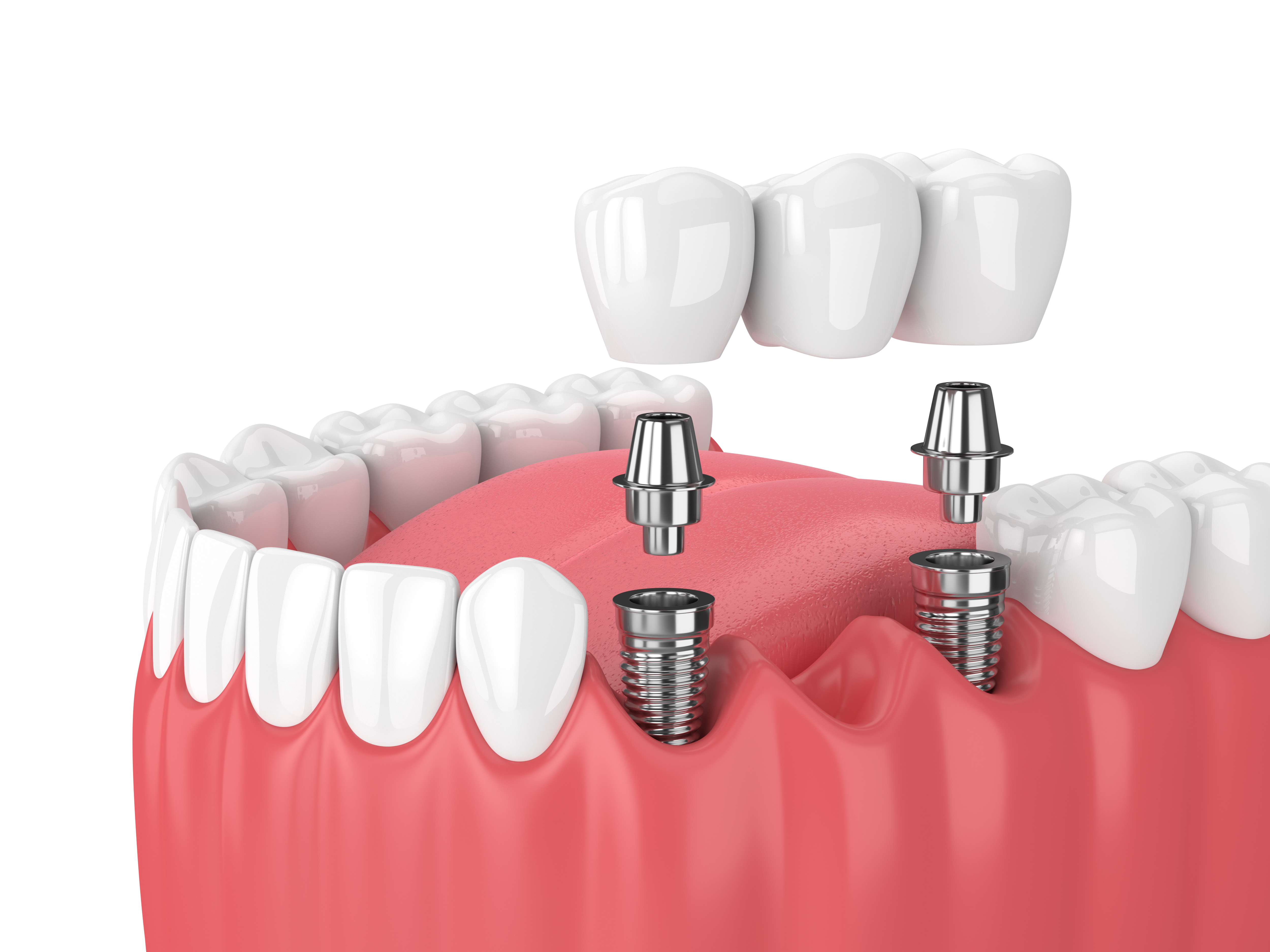 What are the different types of dental prostheses - Bridge on implants