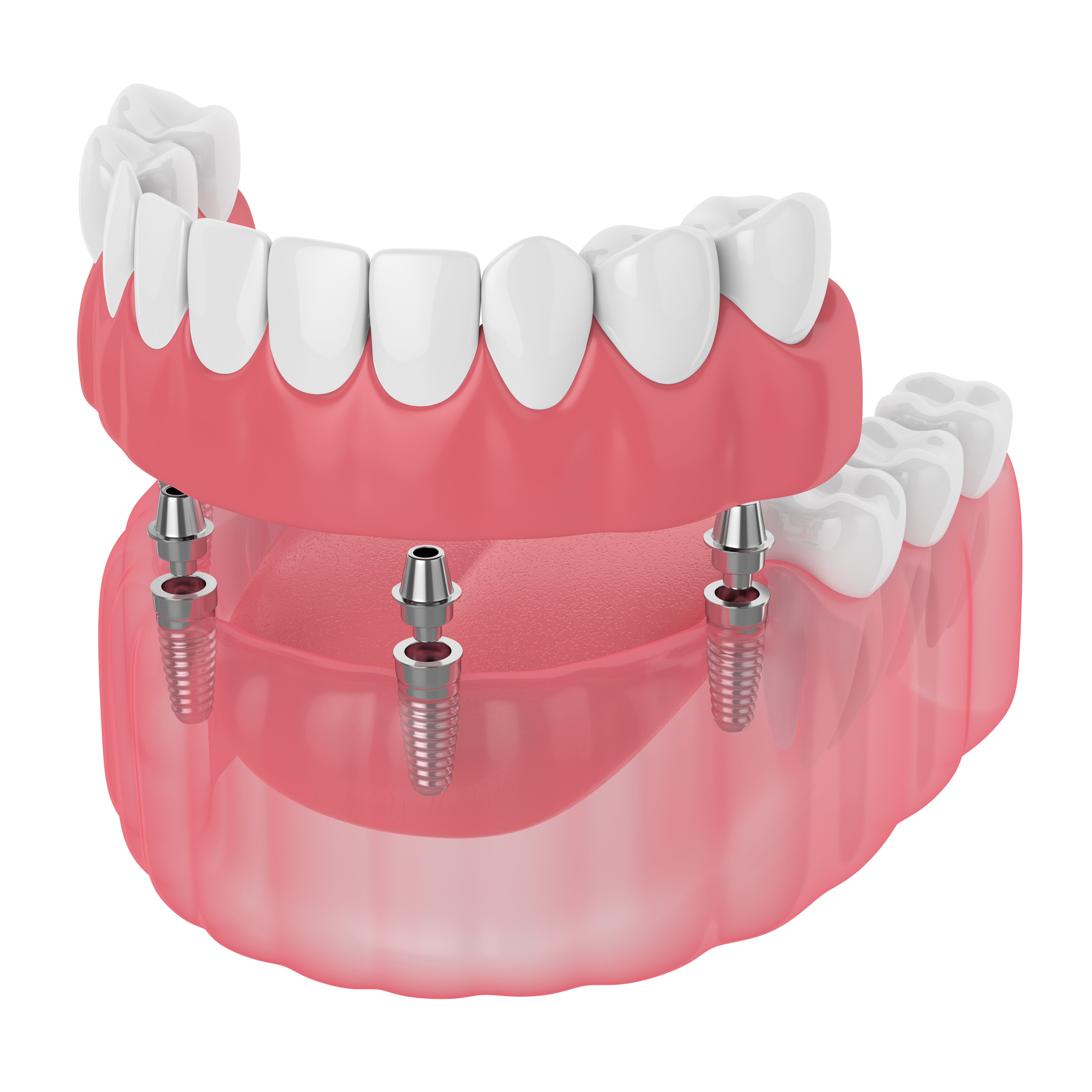 What are the different types of dentures - Fixed full denture