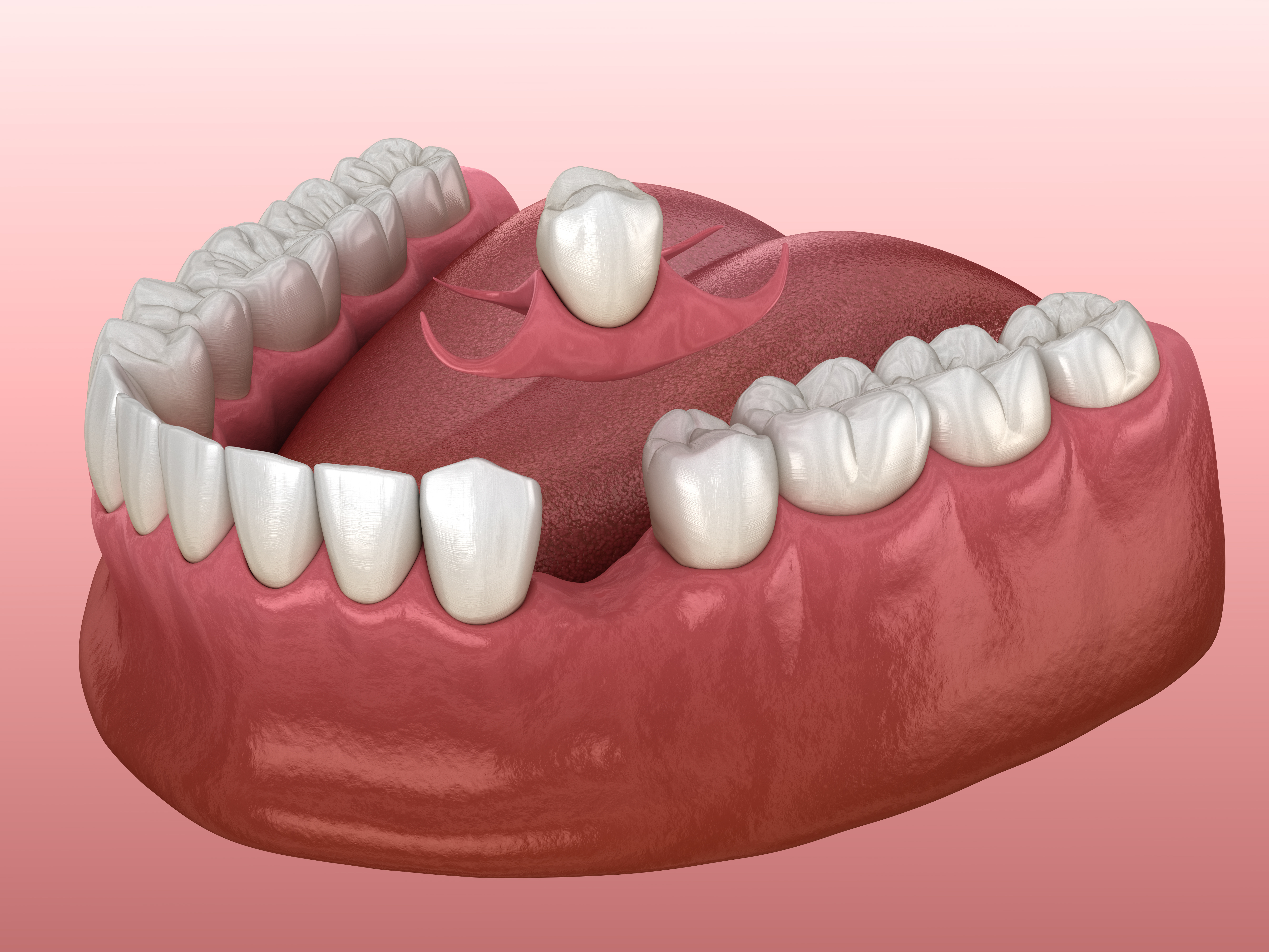 What are the different types of dentures - Immediate dentures