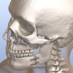 Image 3D d'un crâne présentant une osteotomie mandibulaire