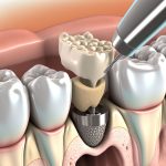 Dental bone grafts