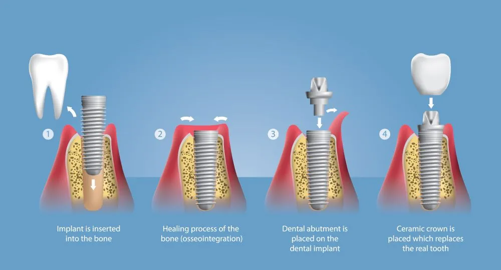 Steps involved in dental implant placement
