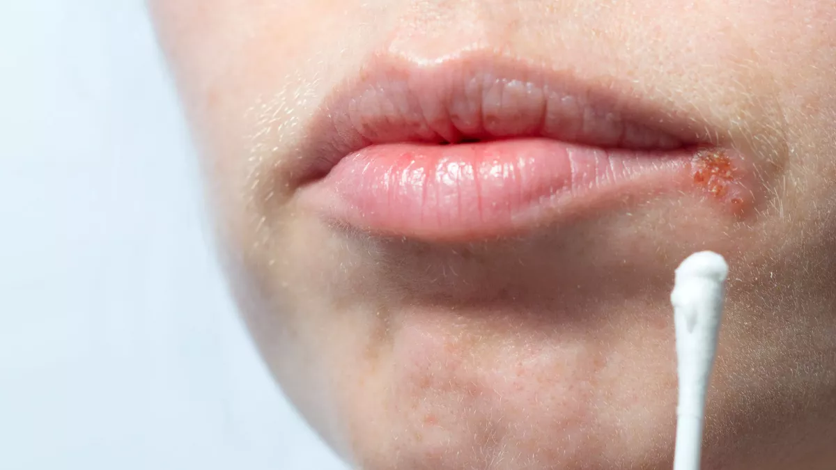 perleche or angular cheilitis